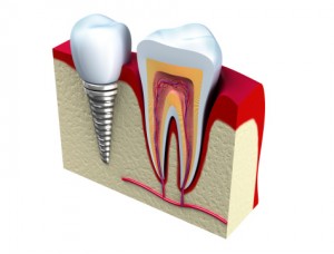 Dental Implants pic