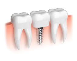 Dental Implants pic